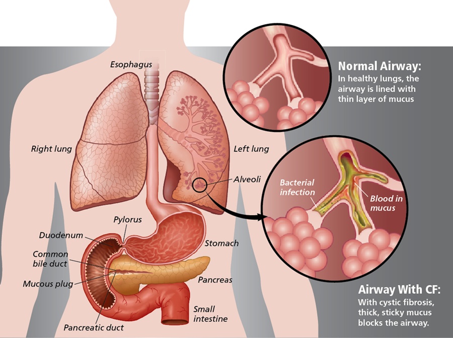 cystic fibrosis lungs diagram